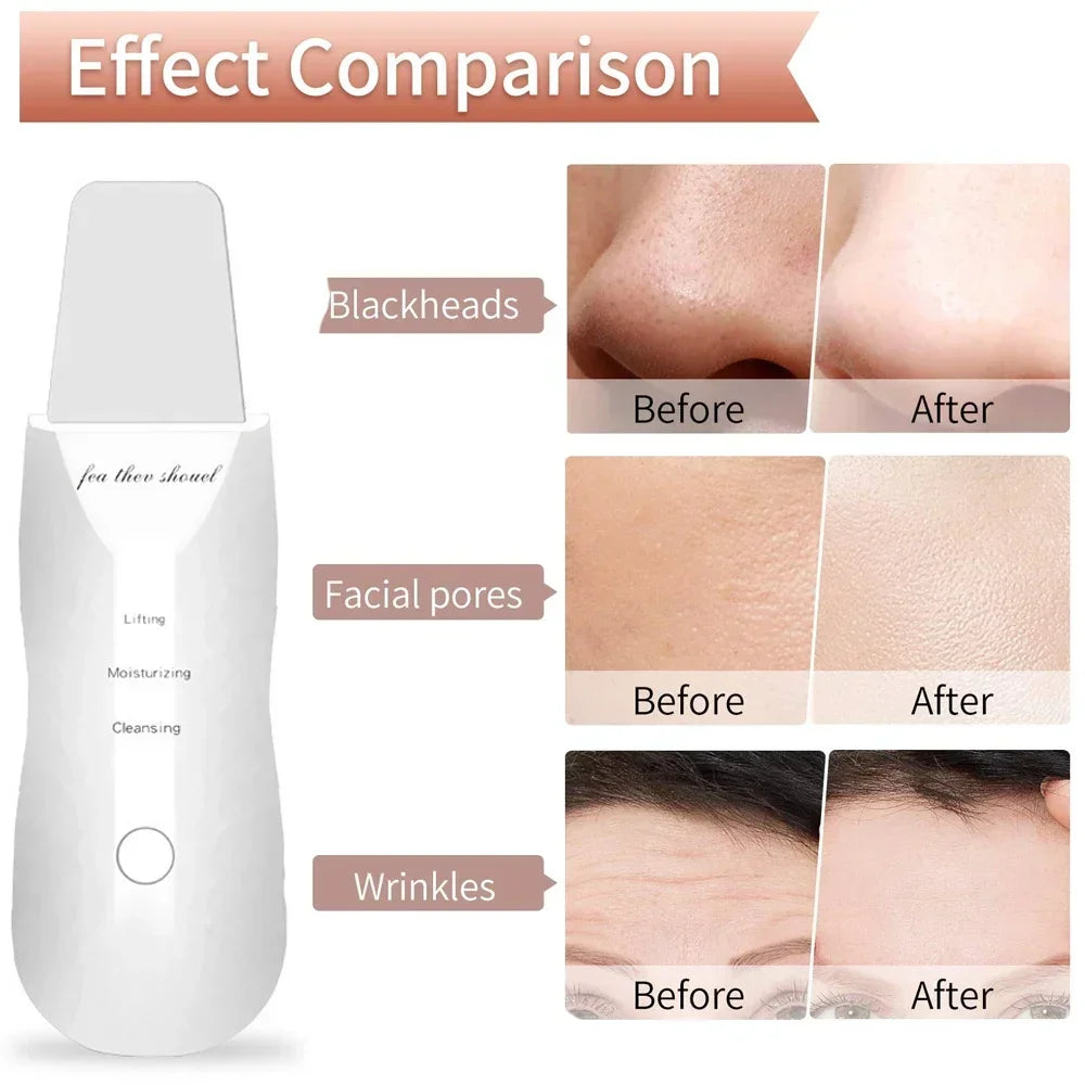 Ultrasonic Skin Scrubber Spatula Peeling Blackhead Remover Deep Face Cleaning Lift Machine Peeling Shovel Pore Cleane